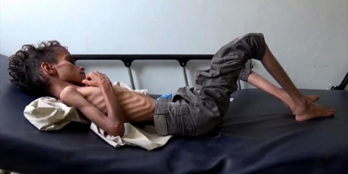 85.000 bambini sono morti di fame in Yemen dall'inizio dell'aggressione saudita 85.000 bambini sono morti di fame in Yemen dall'inizio dell'aggressione saudita